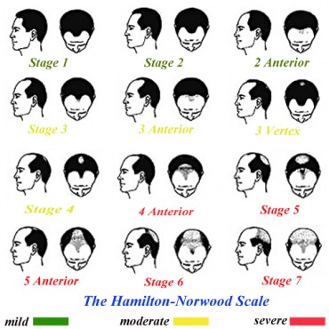 Norwood Chart Pattern Baldness